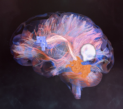 Estimulación Magnética Transcraneal Guiada por Neuroimagen Funcional