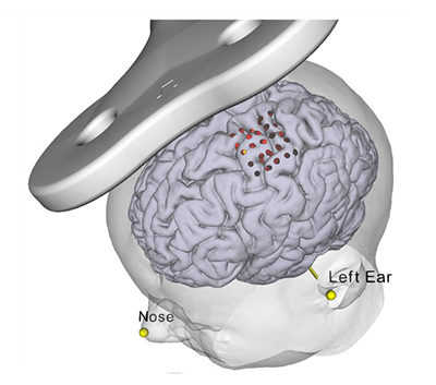 Estimulación Magnética Transcraneal Guiada por Neuroimagen Funcional